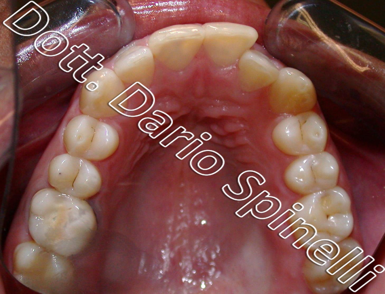 Apparecchio Invisalign o ortodontico: qual è meglio per il tuo sorriso? -  Studio Bellemo - Dentista Pisa