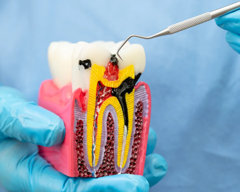 immagine di un modellino di dente cariato